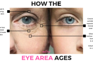 ANTI AGING TIP: How to Treat Dark Circles Around the Eyes, Bags Under Eyes, Saggy Eyelids
