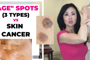 Age Spot Vs Skin Cancer