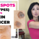 Age Spot Vs Skin Cancer