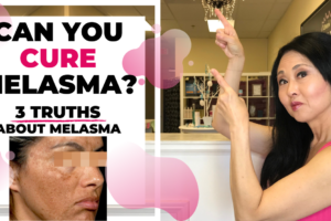 3 Truths of Melasma-CAN YOU CURE MELASMA?