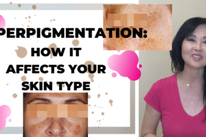 Hyperpigmentation:  Understanding How it Affects your Skin Type