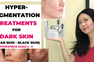 Hyperpigmentation Treatments for Dark Skin: Black Skin Asian Skin and Fitzpatrick 4-6