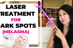 Laser Treatment for Melasma and Dark Spots
