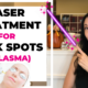 Laser Treatment for Melasma and Dark Spots