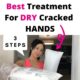 How to treat Dry Cracked Hands