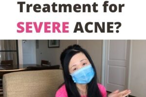 What is the BEST way to treat SEVERE ACNE?