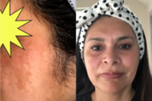 Melasma Treatment Before and After